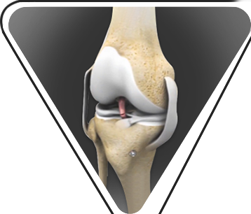 Ligament reconstruction