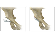 Acetabular Rim Trimming