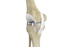 Acromioclavicular (AC) Joint Reconstruction