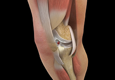 Primary ACL Repair