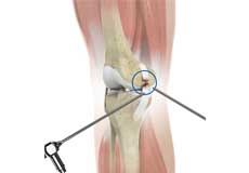 Arthroscopic Reconstruction of the Knee for Ligament Injuries