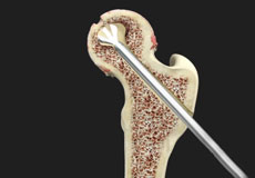 Core Decompression for Avascular Necrosis of the Hip