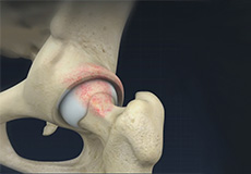 Femoral Osteoplasty