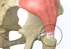 Gluteus Tendon Tear