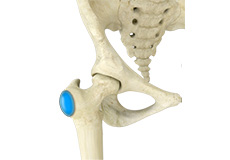 Hip Bursitis