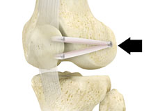 Medial Patellofemoral Ligament Reconstruction