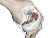 Meniscal Injuries