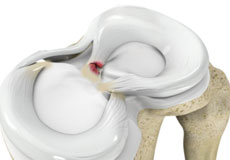 Meniscus Root Tear