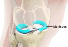 Meniscus Tears