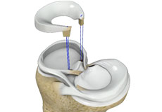 Meniscal Transplantation