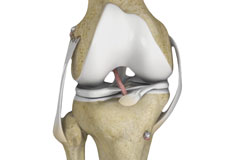 Multiligament Reconstruction of the Knee