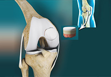 Osteochondritis Dissecans of the Knee