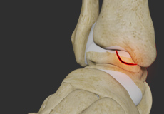 Osteochondroplasty