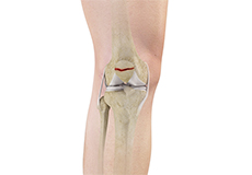 Patella Fracture