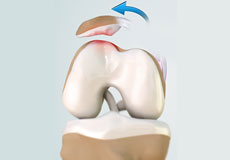 Patellofemoral Realignment