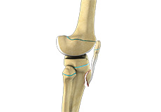 Pediatric Tibial Tubercle Fractures