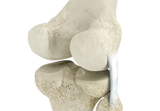 Posterolateral Corner (PLC) Reconstruction