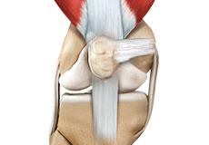 Quadriceps Tendon Rupture and Repair