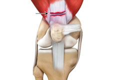 Quadriceps Tendon Rupture