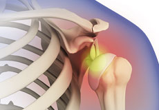 Shoulder Disorders