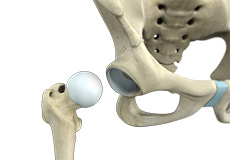 Surgical Dislocation of the Hip