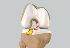 Tibial Eminence Fractures